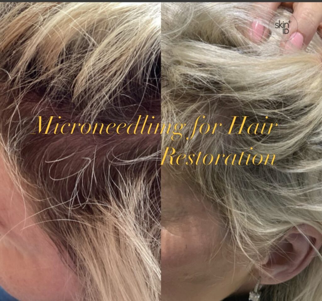 Microneedling for Hair Restoration