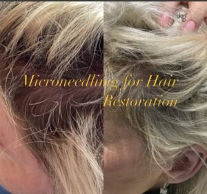 Microneedling for Hair Restoration